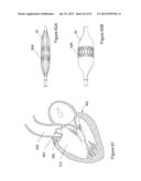  INFLATABLE MEDICAL DEVICES  diagram and image