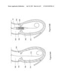  INFLATABLE MEDICAL DEVICES  diagram and image