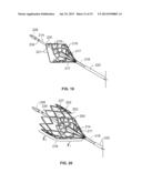 IVC FILTER CATHETER WITH IMAGING MODALITY diagram and image