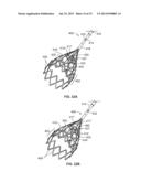 IVC FILTER CATHETER WITH IMAGING MODALITY diagram and image