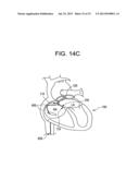 SINGLE DISC OCCLUSIONARY PATENT FORAMEN OVALE CLOSURE DEVICE diagram and image