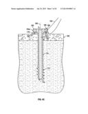 COMPRESSION SCREW SYSTEM diagram and image