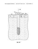 COMPRESSION SCREW SYSTEM diagram and image