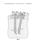 COMPRESSION SCREW SYSTEM diagram and image