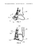 Blade Fixation for Ankle Fusion and Arthroplasty diagram and image