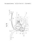 Use of Electric Fields for Reducing Patient Discomfort During     Defibrillation diagram and image