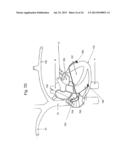 Use of Electric Fields for Reducing Patient Discomfort During     Defibrillation diagram and image