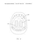 APPARATUS AND METHOD FOR TREATING OBSTRUCTIVE SLEEP APNEA diagram and image