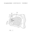 APPARATUS AND METHOD FOR TREATING OBSTRUCTIVE SLEEP APNEA diagram and image