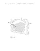 APPARATUS AND METHOD FOR TREATING OBSTRUCTIVE SLEEP APNEA diagram and image