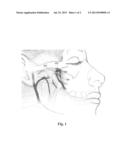 STIMULATION METHOD FOR A SPHENOPALATINE GANGLION, SPHENOPALATINE NERVE,     VIDIAN NERVE, OR BRANCH THEREOF FOR TREATMENT OF MEDICAL CONDITIONS diagram and image