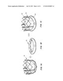 MEANS FOR CONTROLLED SEALING OF ENDOVASCULAR DEVICES diagram and image