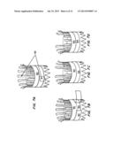 MEANS FOR CONTROLLED SEALING OF ENDOVASCULAR DEVICES diagram and image