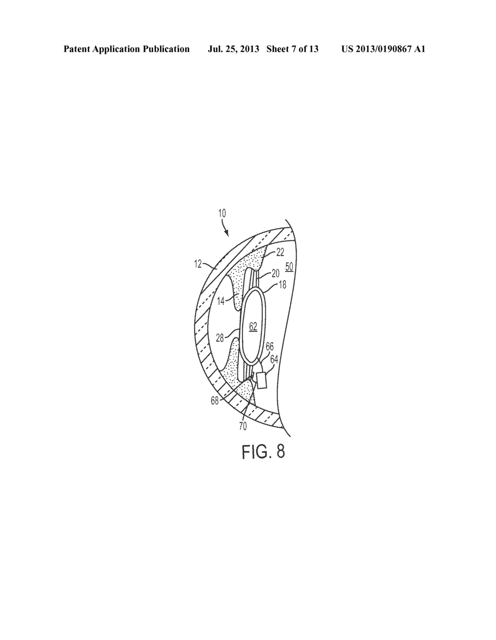 ADJUSTABLE FLUIDIC TELESCOPE - diagram, schematic, and image 08