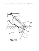 RIM ANCHORING SYSTEMS FOR FLEXIBLE SURGICAL IMPLANTS FOR REPLACING     CARTILAGE diagram and image