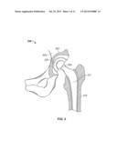 METHOD AND SYSTEM FOR ALIGNING A PROSTHESIS DURING SURGERY diagram and image