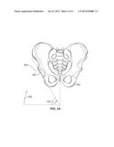 METHOD AND SYSTEM FOR ALIGNING A PROSTHESIS DURING SURGERY diagram and image