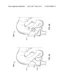 METHOD AND SYSTEM FOR ALIGNING A PROSTHESIS DURING SURGERY diagram and image