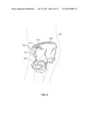 METHOD AND SYSTEM FOR ALIGNING A PROSTHESIS DURING SURGERY diagram and image