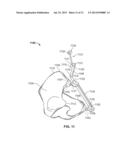 METHOD AND SYSTEM FOR ALIGNING A PROSTHESIS DURING SURGERY diagram and image