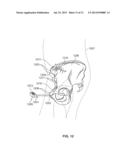 METHOD AND SYSTEM FOR ALIGNING A PROSTHESIS DURING SURGERY diagram and image