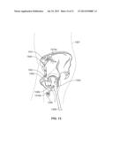 METHOD AND SYSTEM FOR ALIGNING A PROSTHESIS DURING SURGERY diagram and image