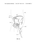 METHOD AND SYSTEM FOR ALIGNING A PROSTHESIS DURING SURGERY diagram and image