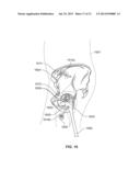 METHOD AND SYSTEM FOR ALIGNING A PROSTHESIS DURING SURGERY diagram and image