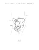 METHOD AND SYSTEM FOR ALIGNING A PROSTHESIS DURING SURGERY diagram and image