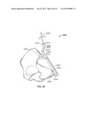 METHOD AND SYSTEM FOR ALIGNING A PROSTHESIS DURING SURGERY diagram and image