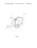 METHOD AND SYSTEM FOR ALIGNING A PROSTHESIS DURING SURGERY diagram and image