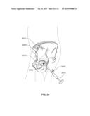 METHOD AND SYSTEM FOR ALIGNING A PROSTHESIS DURING SURGERY diagram and image