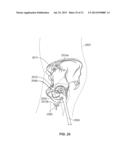 METHOD AND SYSTEM FOR ALIGNING A PROSTHESIS DURING SURGERY diagram and image