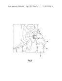 Device for Infiltration of Approximal Enamel Lesions of Teeth diagram and image