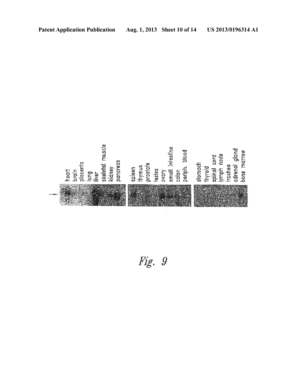 Genes Differentially Expressed in Breast Cancer - diagram, schematic, and image 11