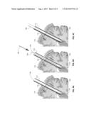 ENDOSCOPIC PORTS FOR MINIMALLY INVASIVE SURGICAL ACCESS AND METHODS OF USE     THEREOF diagram and image