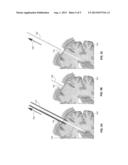 ENDOSCOPIC PORTS FOR MINIMALLY INVASIVE SURGICAL ACCESS AND METHODS OF USE     THEREOF diagram and image