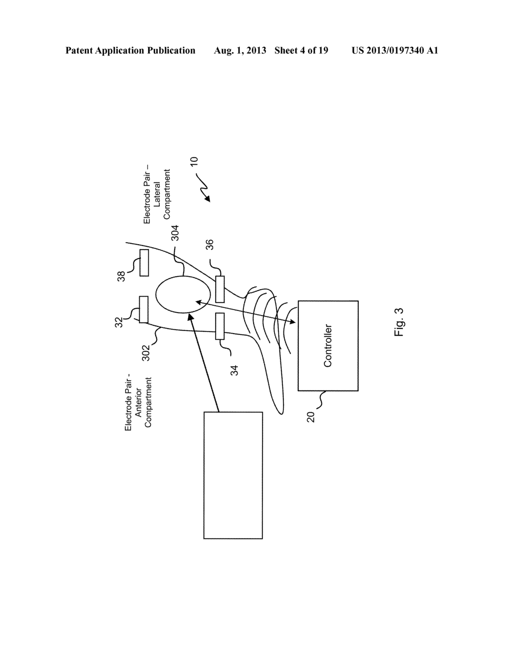 Potential Artery-to-Vein Disease State Detection - diagram, schematic, and image 05