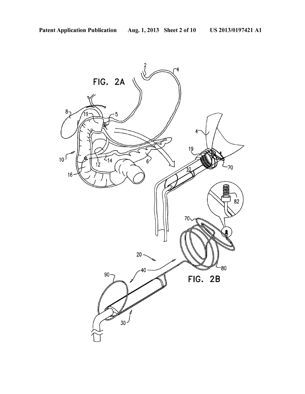 PANCREATICOBILIARY DIVERSION DEVICE - diagram, schematic, and image 03