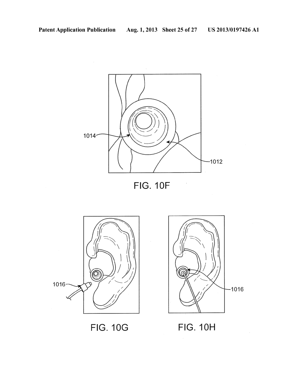 SYSTEMS AND METHODS FOR ANESTHETIZING EAR TISSUE - diagram, schematic, and image 26