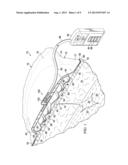 REDUCED-PRESSURE DRESSING ASSEMBLIES FOR USE IN APPLYING A CLOSING FORCE diagram and image