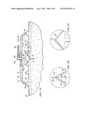 REDUCED-PRESSURE DRESSING ASSEMBLIES FOR USE IN APPLYING A CLOSING FORCE diagram and image