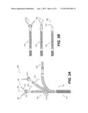 MEDICAL DEVICE HAVING A TENSIONABLE COUPLING diagram and image