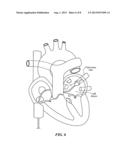 BALLOON DESIGN TO ENHANCE COOLING UNIFORMITY diagram and image