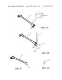 TOTAL JOINT ARTHROPLASTY SYSTEM diagram and image