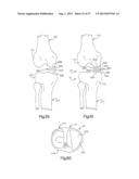 ROBOTIC ARTHROPLASTY SYSTEM INCLUDING NAVIGATION diagram and image