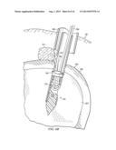 BIASED WEDGE SUTURE ANCHOR AND METHOD FOR SOFT TISSUE REPAIR diagram and image