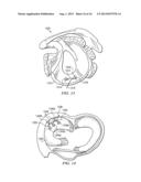 BIASED WEDGE SUTURE ANCHOR AND METHOD FOR SOFT TISSUE REPAIR diagram and image