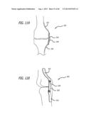 EXTRA-ARTICULAR IMPLANTABLE MECHANICAL ENERGY ABSORBING SYSTEMS AND     IMPLANTATION METHOD diagram and image