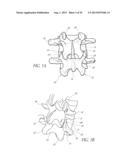 VERTEBRAL FACET JOINT PROSTHESIS AND METHOD OF FIXATION diagram and image